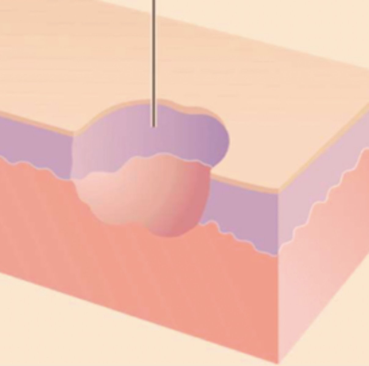 <p>¿lesión?</p><p>¿primaria o secundaria?</p>