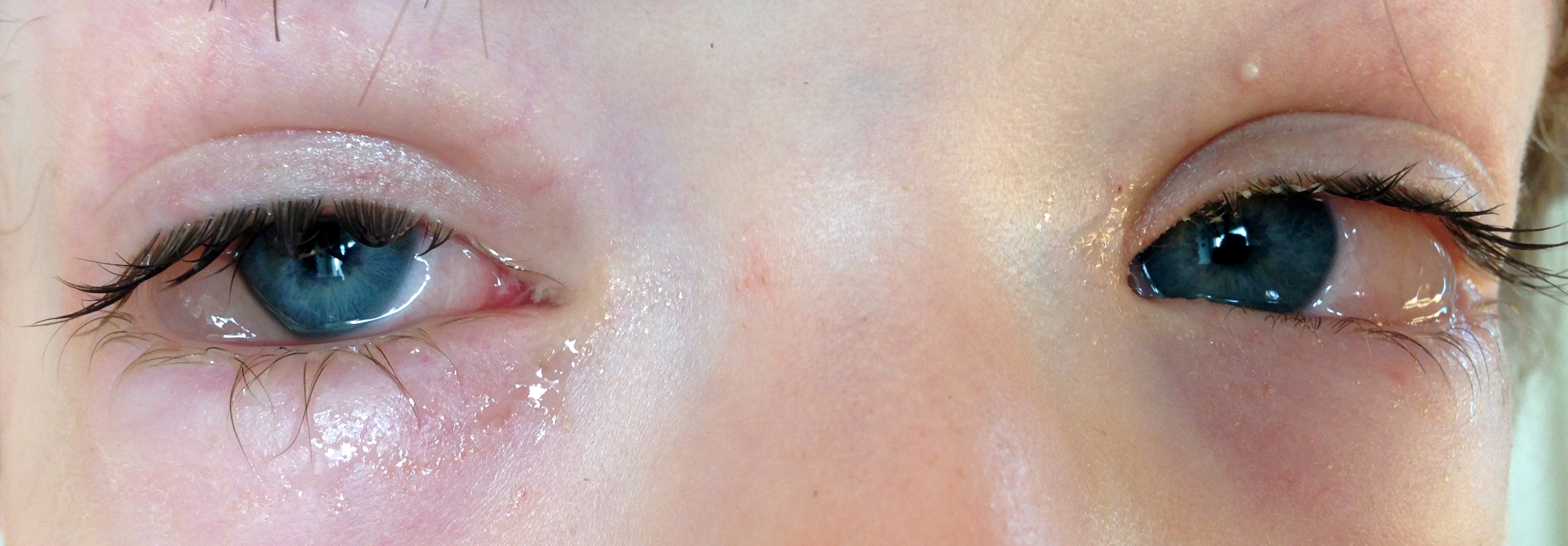 <p><span>What does Chemosis mean?</span></p><p><br></p>