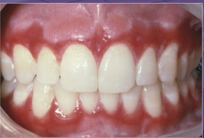 <p>what is NOT part of the differential dx</p><p>lichen planus </p><p>pemphigus vulgaris </p><p>erythema multiforme </p><p>mucous membrane pemphigoid </p>