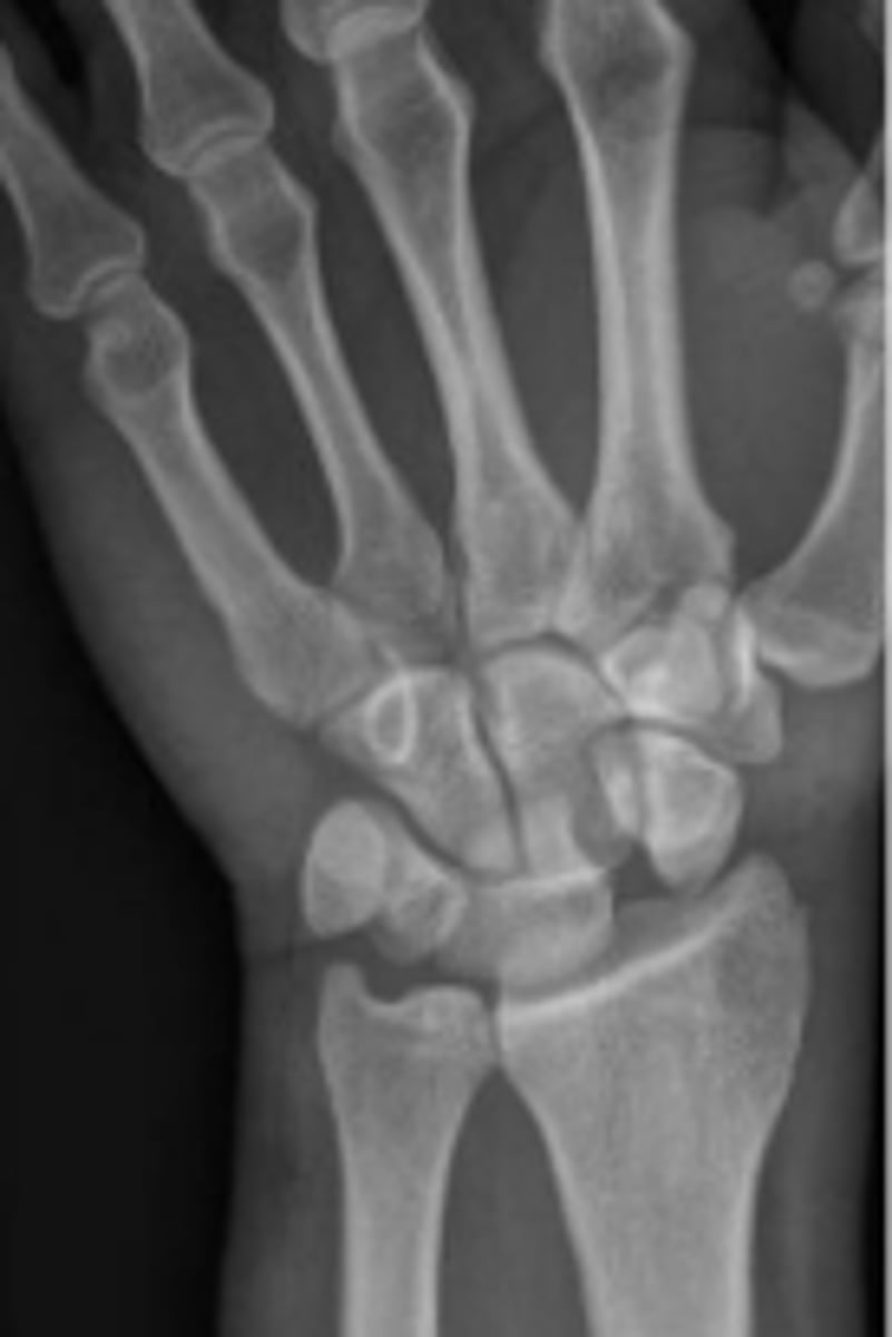 <p>Mechanism of Injury: Fall onto an outstretched hand.</p><p>What is the named sign given to widening of the scapholunate spacing?</p>
