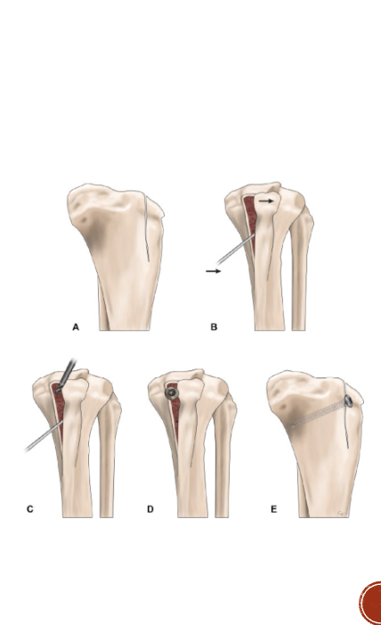 <p>Lateral imbrication</p><p>Trochlear modification</p><p>Tibial crest (tuberosity) transportation</p>