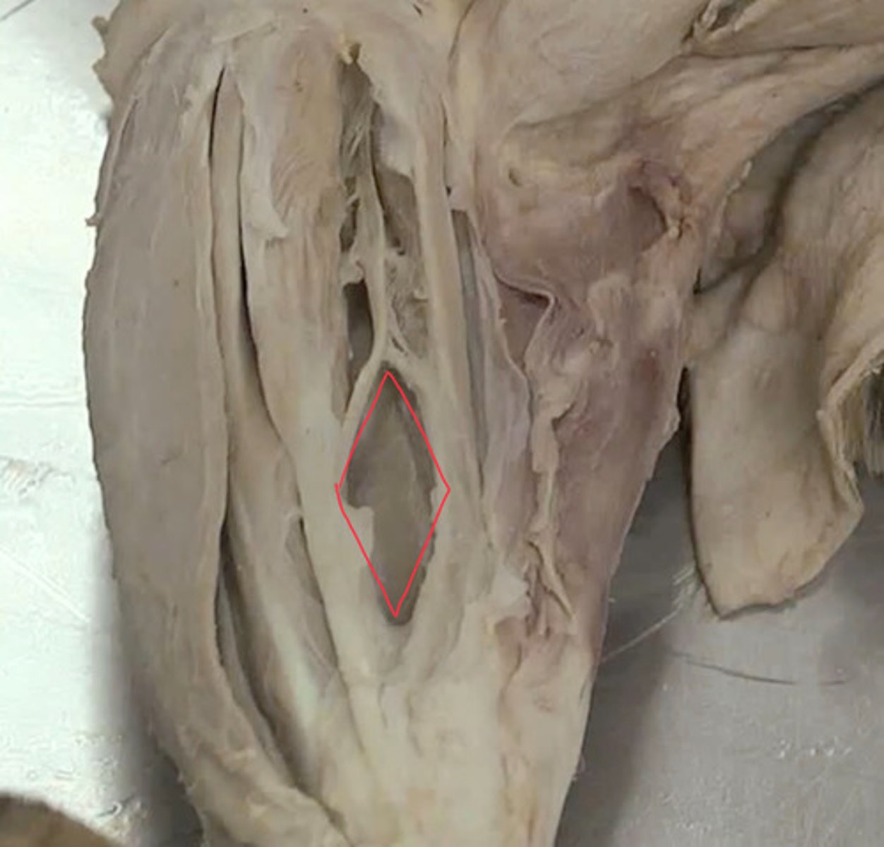 <p>ocupa el espacio interóseo entre radio y cúbito.</p><p>Origen: borde md cúbito</p><p>Inserción: cara cd radio</p><p>Función: pronador.</p><p>Inervación: n. mediano.</p><p>Exclusivo carnívoros</p>