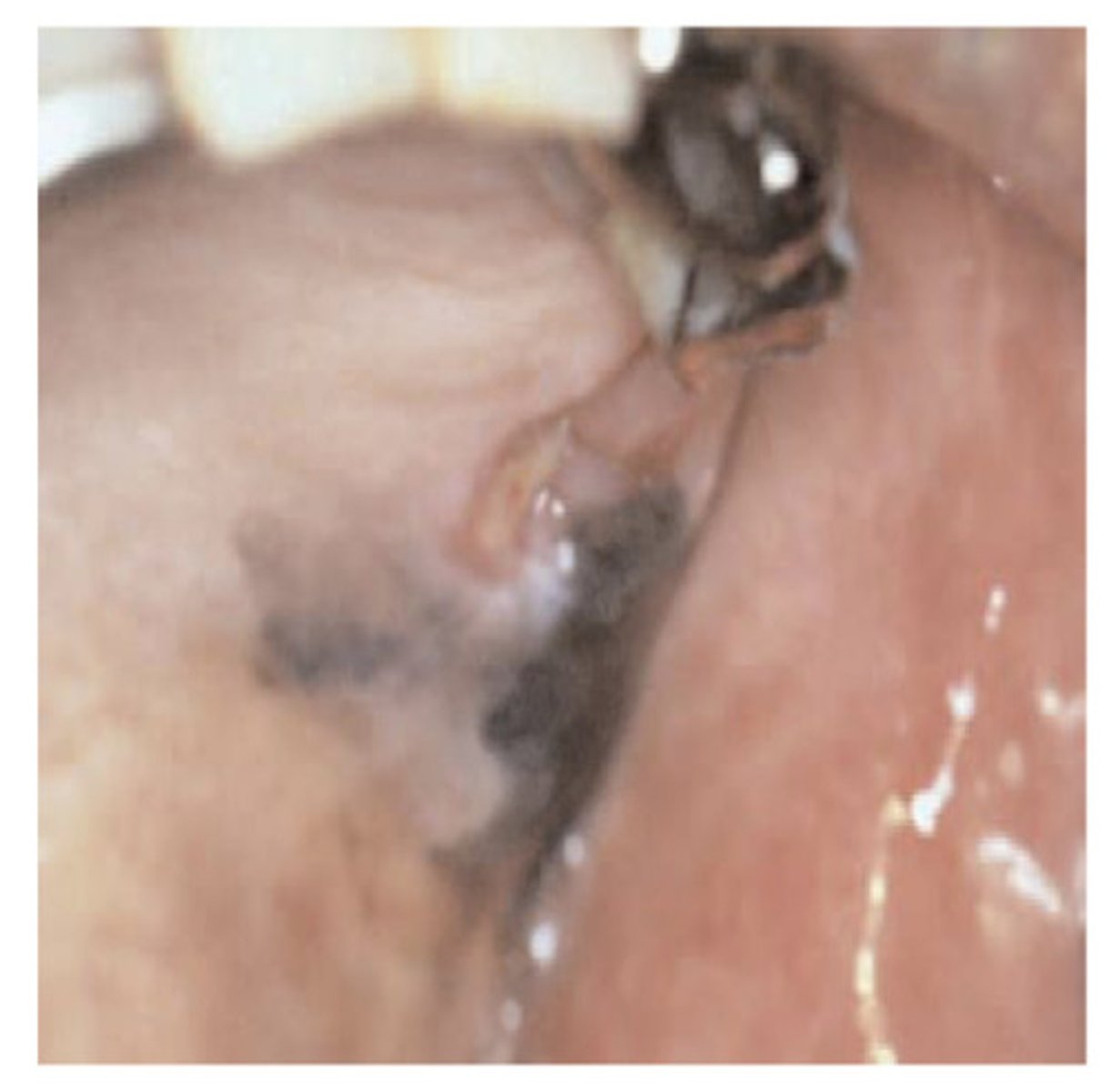 <p>Quite rare to be seen in the mouth - there is a spreading blue/black area with diffuse margins - what am i?</p>