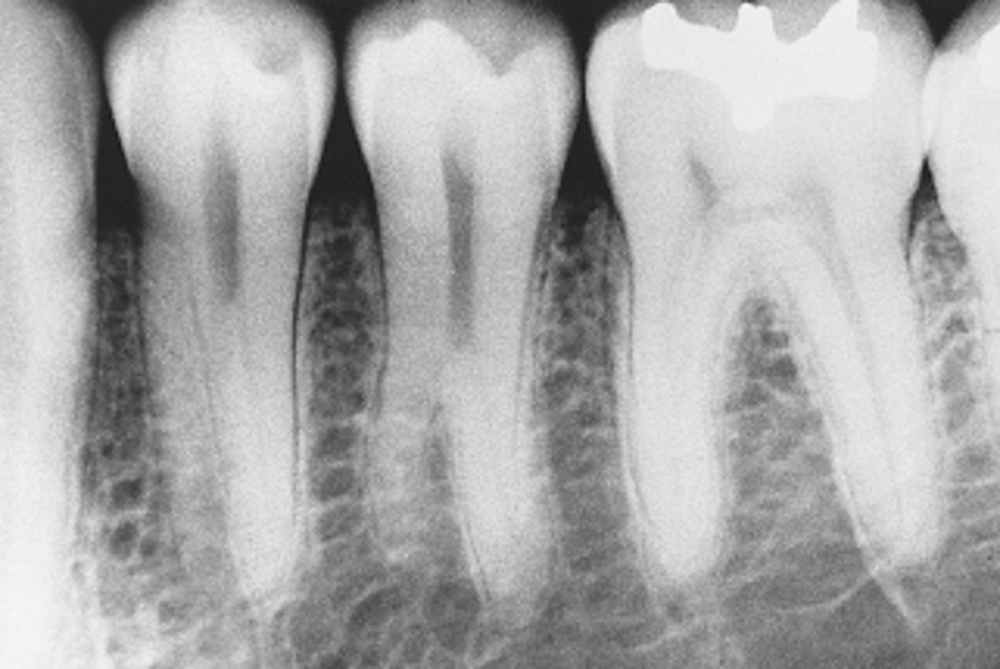 <p>supernumerary roots on the mandibular premolars.</p><p>This radiographic image shows supernumerary roots on the mandibular premolars. Taurodontic teeth, or bull's teeth, show large pulp chambers and short roots, not seen in this radiograph. Mulberry molars result from congenital syphilis. Small globules of enamel make up the occlusal surface of the first molar. Dilaceration is a sharp bend or curve in the root.</p>