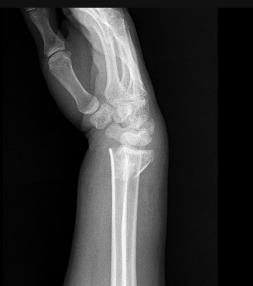 <p>A transverse distal radius fracture DORSALLY displaces and extra-articular - dinner fork deformity</p>