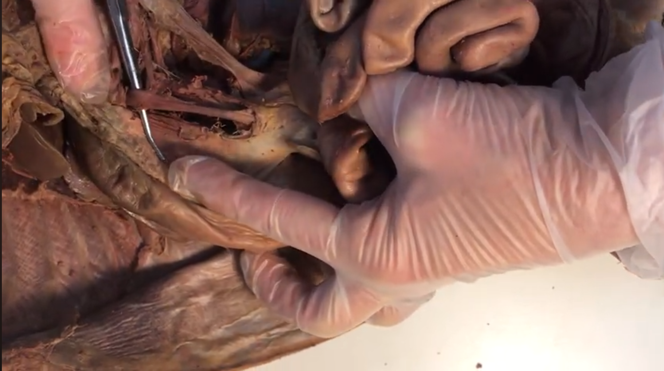 <p>What vein is this</p>