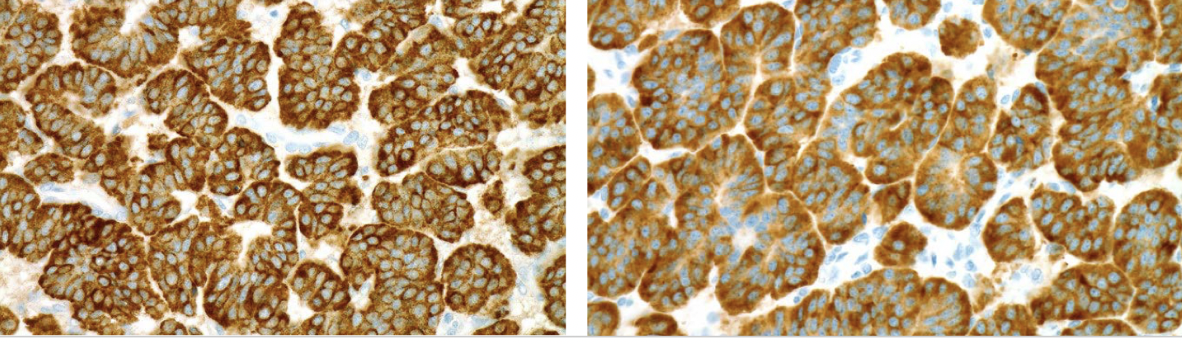 <p>IHC positive stains for carcinoid lung tumor ?</p>