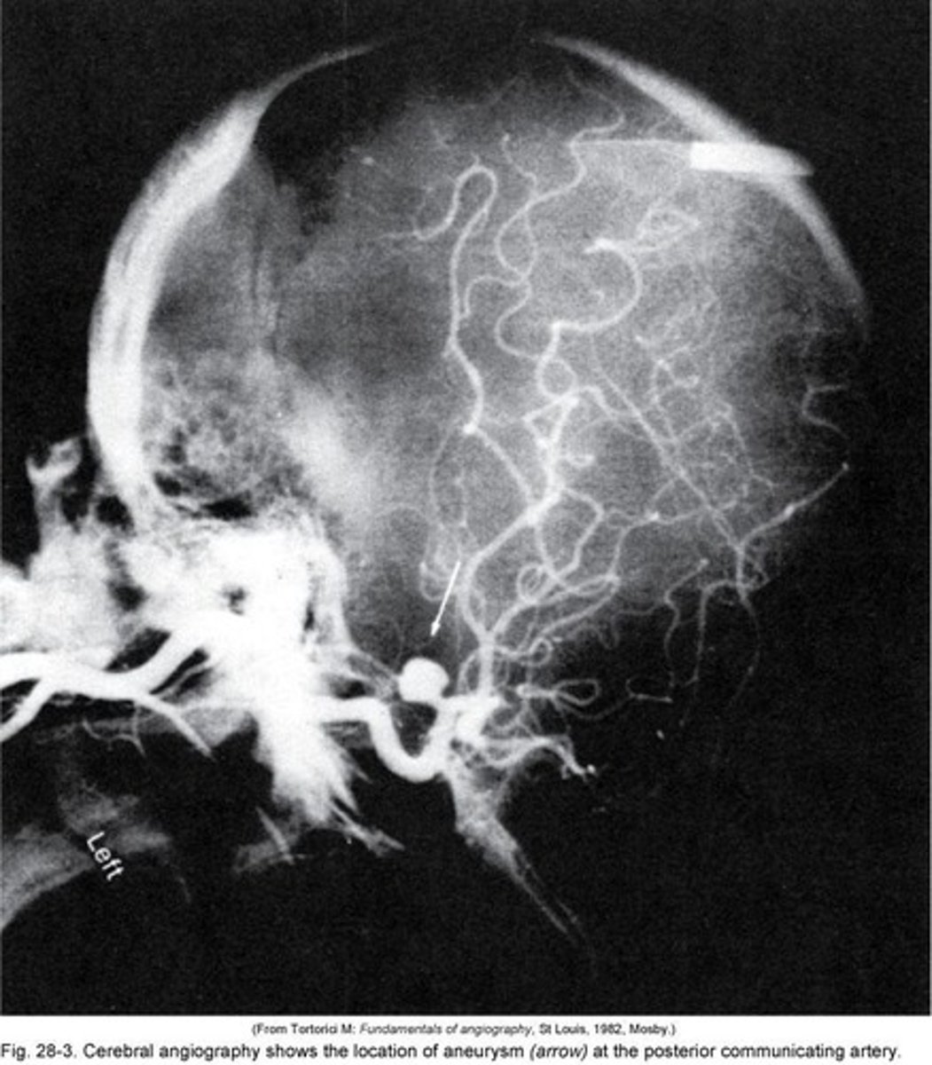 <p>Outpouching of a blood vessel wall.</p>