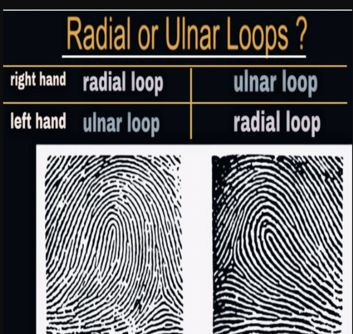 <p>radial loop on right thumb</p>