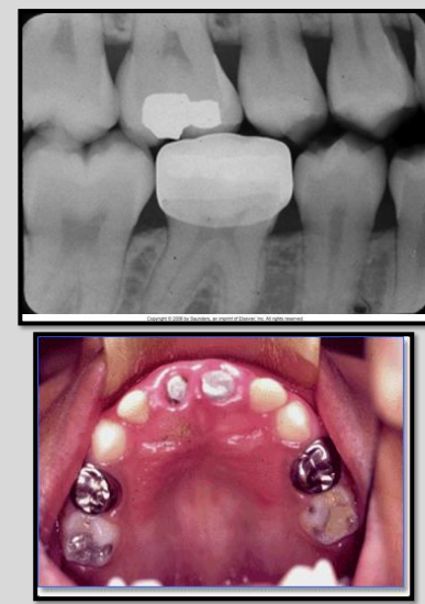 <ul><li><p>SS crowns and chrome crowns have <strong>smooth and regular margins </strong></p></li><li><p>usually used as a temporary restoration </p></li><li><p>Thin and do not absorb as much xrays → appear radiopaque but not as densely as amalgam or gold </p></li><li><p>may have some “see-through”ish areas on radiograph. </p></li></ul><p></p>