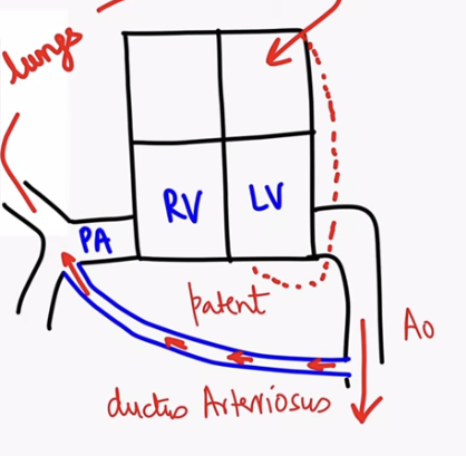 <p>Most blood is bypassing RV. Due o connection, blood is going to pulmonary artery and then to LA→LV </p>