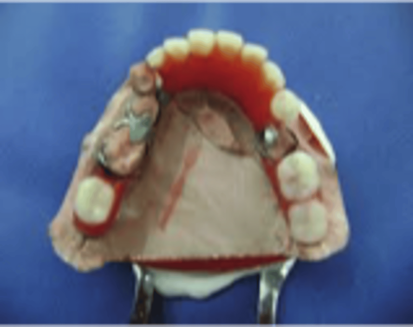 <p>Biomechanical classification in which support comes from both teeth and soft tissue</p>