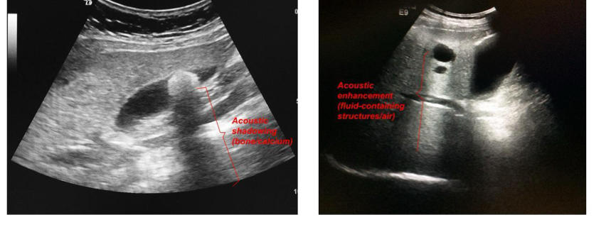 <p>Shadowing occurs when there is a region that doenst le US go thruCalci in kidney and gallbladder cause posterior acoustic shadowing, hepatic cyst (cystic structure typically fillled with liquid) shows posterior acoustic enhancement.</p>