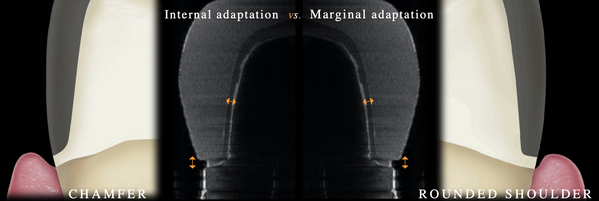 <p>rounded shoulder (but no affect on clinical success rate); p< 0.01 </p>