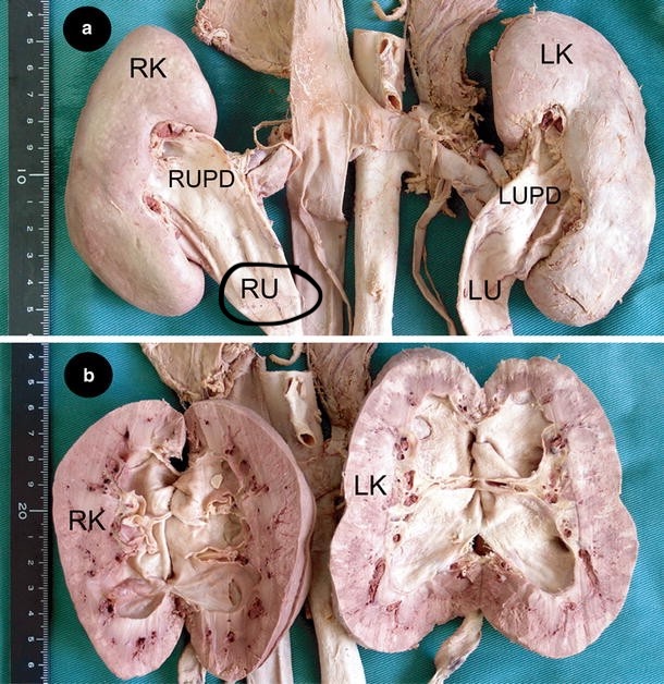 <p>A tube that carries urine from the right kidney to the bladder</p><p>BELOW and ATTACHED to the kidney, comes off the right kidney</p>