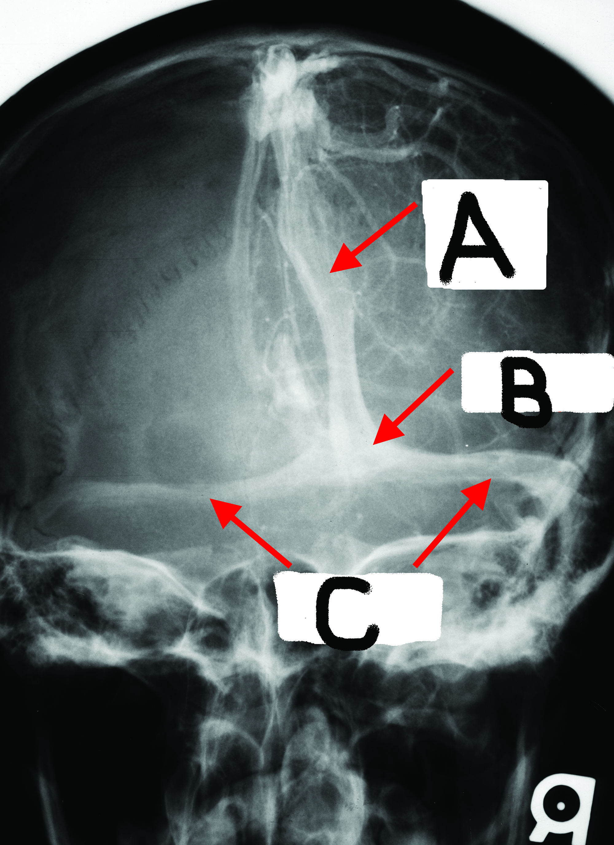 <p>Which of the following letters represents the Superior sagittal sinus?</p>