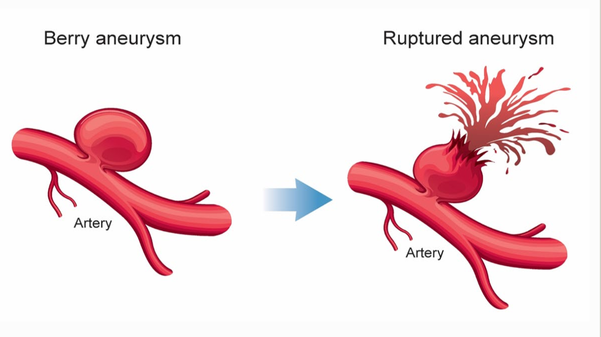 <p>aneurysms </p>