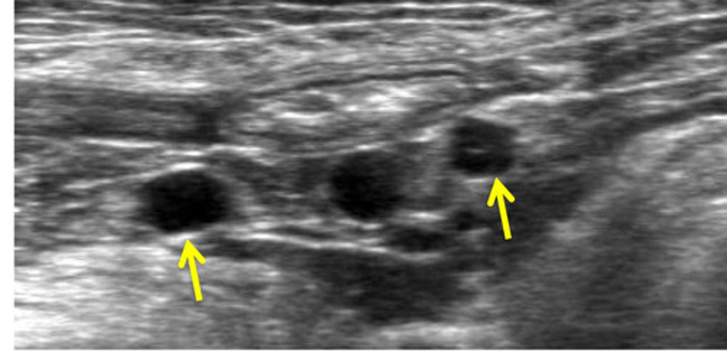 <p>what arteries are the yellow arrows? (apart of the aortic trifurcation)</p>