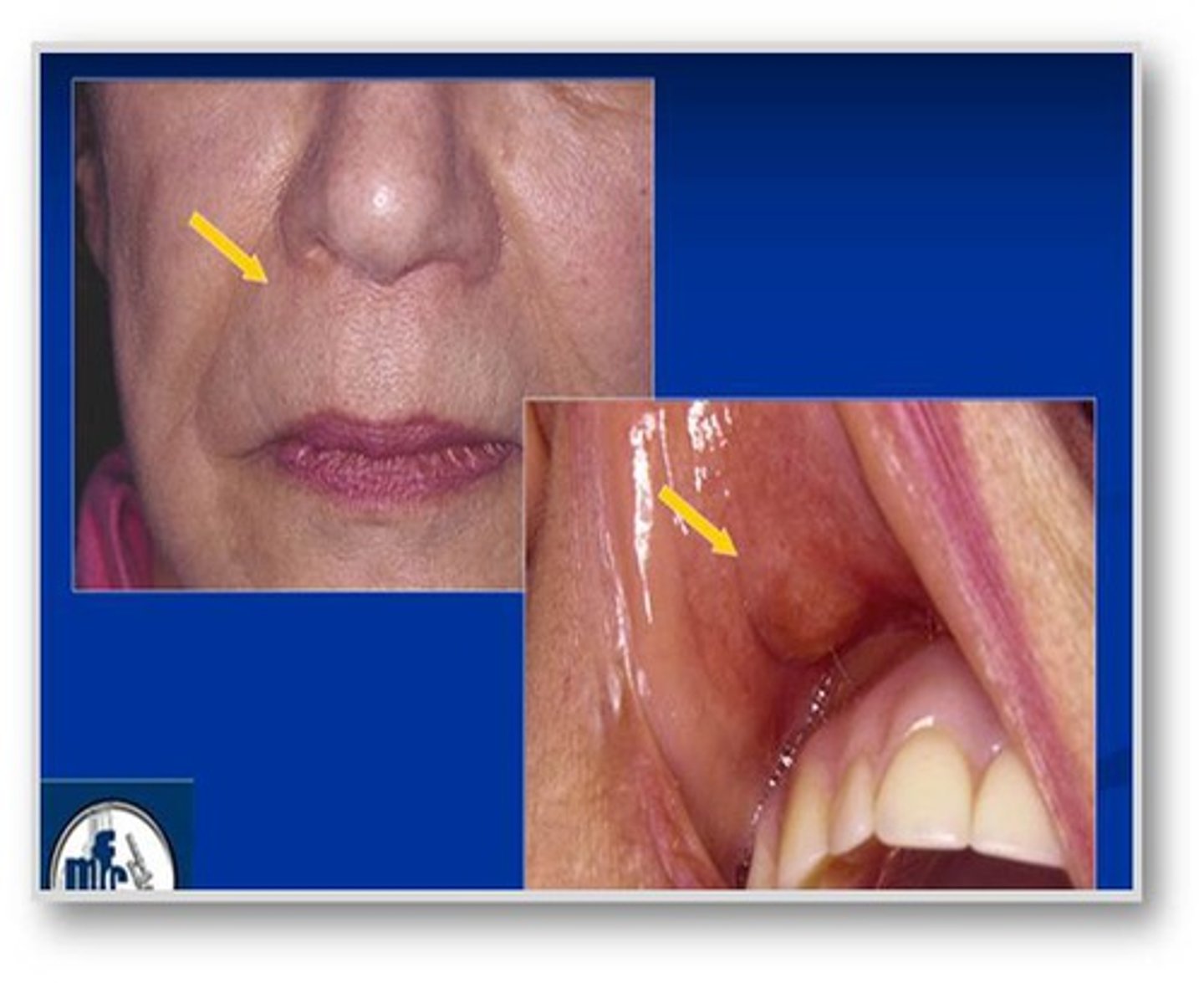 <p>In canine-lateral region of maxillary lip.</p>