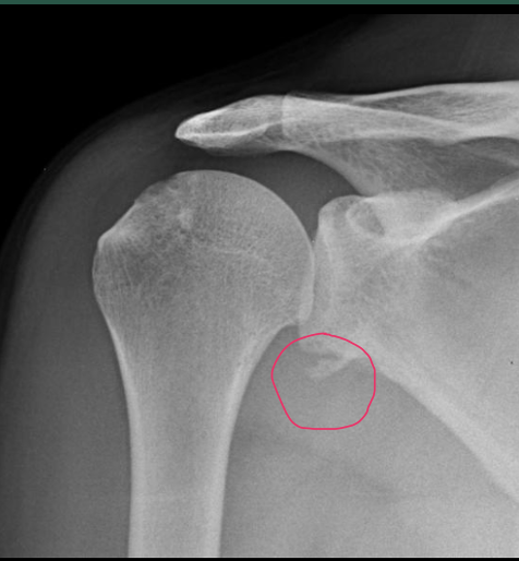 <p>A Bankart lesion is a specific type of shoulder injury that involves damage to the labrum of the glenoid cavity (the socket of the shoulder joint). This injury often occurs in conjunction with anterior shoulder dislocations or subluxations, where the humeral head (upper arm bone) partially or completely moves out of the glenoid cavity. The Bankart lesion is an important consideration in cases of recurrent shoulder instability.</p>