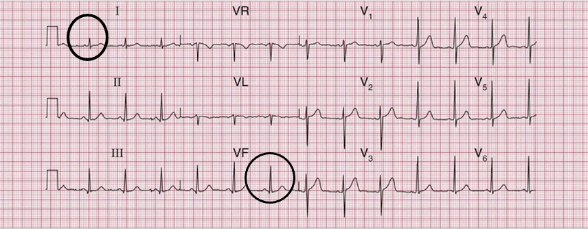 <p>both leads I and aVF are positively deflected</p>
