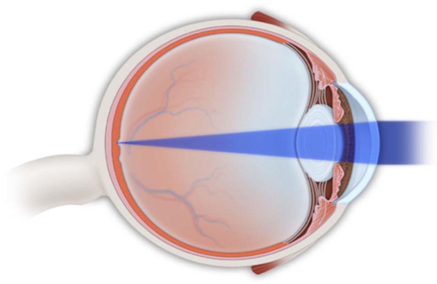 <p>normal, focal point rests on the retina</p>
