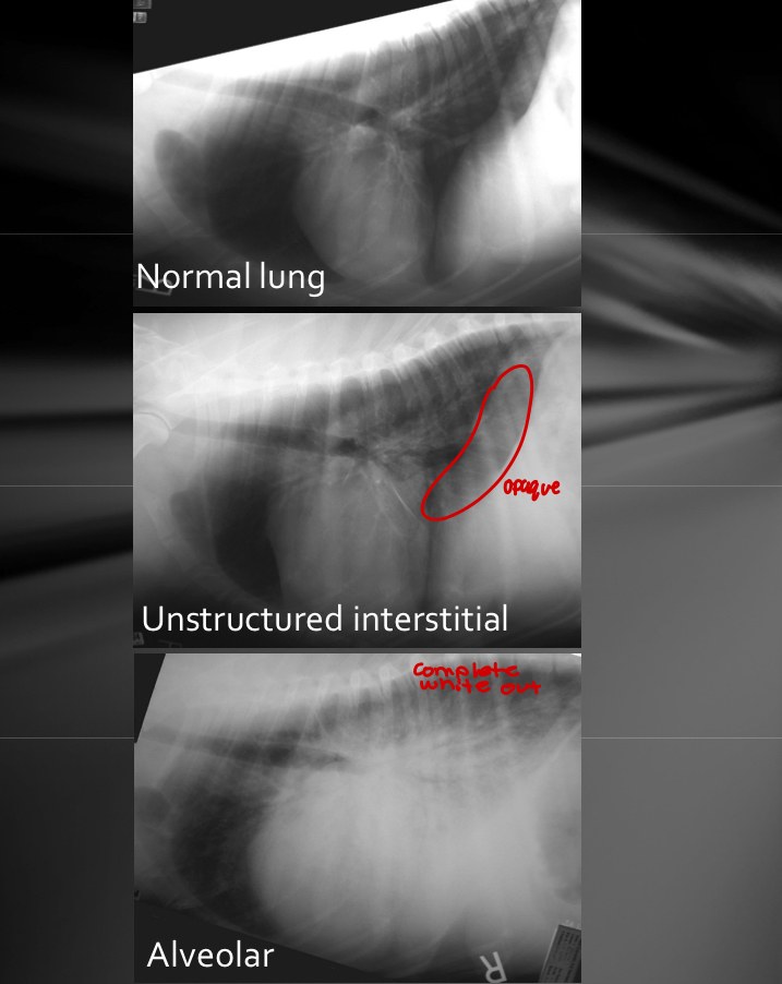 <ul><li><p><span>Increased pulmonary opacity to the point where <strong>vessels CANNOT</strong> <strong>be identified</strong></span></p></li><li><p><span>Caused by decreased volume of air in lungs</span></p><ul><li><p><span>Lungs filled with crap (consolidation) - blood, pus, water, cells</span></p></li><li><p><span>Lung is collapsed (atelectasis)</span></p></li><li><p>pulmonary edema → interstitial pattern early → alveolar pattern when bad</p></li></ul></li><li><p><span>Air bronchograms - trees in the fog</span></p><ul><li><p><span>Could be alveolar even if you don’t see the “trees”</span></p></li><li><p><span>gas filled bronchi contrasting with soft tissue opaque lungs</span></p></li><li><p><span>go away when soft tissue or fluid fills bronchial lumen as well</span></p></li></ul></li></ul><p>Differentials</p><ul><li><p><span>NOT possible to determine what kind of fluid/cells makes increased density on radiographs</span></p></li><li><p><span>Consider</span></p><ul><li><p><span>Location + distribution</span></p></li><li><p><span>Other radiographic abnormalities (heart, mediastinum, ribs)</span></p></li></ul></li><li><p><span>Possible causes</span></p><ul><li><p><span>Pulmonary edema (cardiogenic and noncardiogenic like electric cord)</span></p></li><li><p><span>Pneumonia</span></p></li><li><p><span>Hemorrhage</span></p></li><li><p><span>Atelectasis - no air/collapse</span></p></li><li><p><span>other</span></p></li></ul></li></ul><img src="https://knowt-user-attachments.s3.amazonaws.com/603691f6-b8ca-4946-b7ea-7c169c629e5c.jpg" data-width="100%" data-align="center"><p></p>