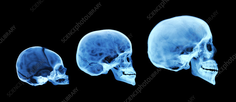 <p>How does a newborn skull differ from an adult</p>