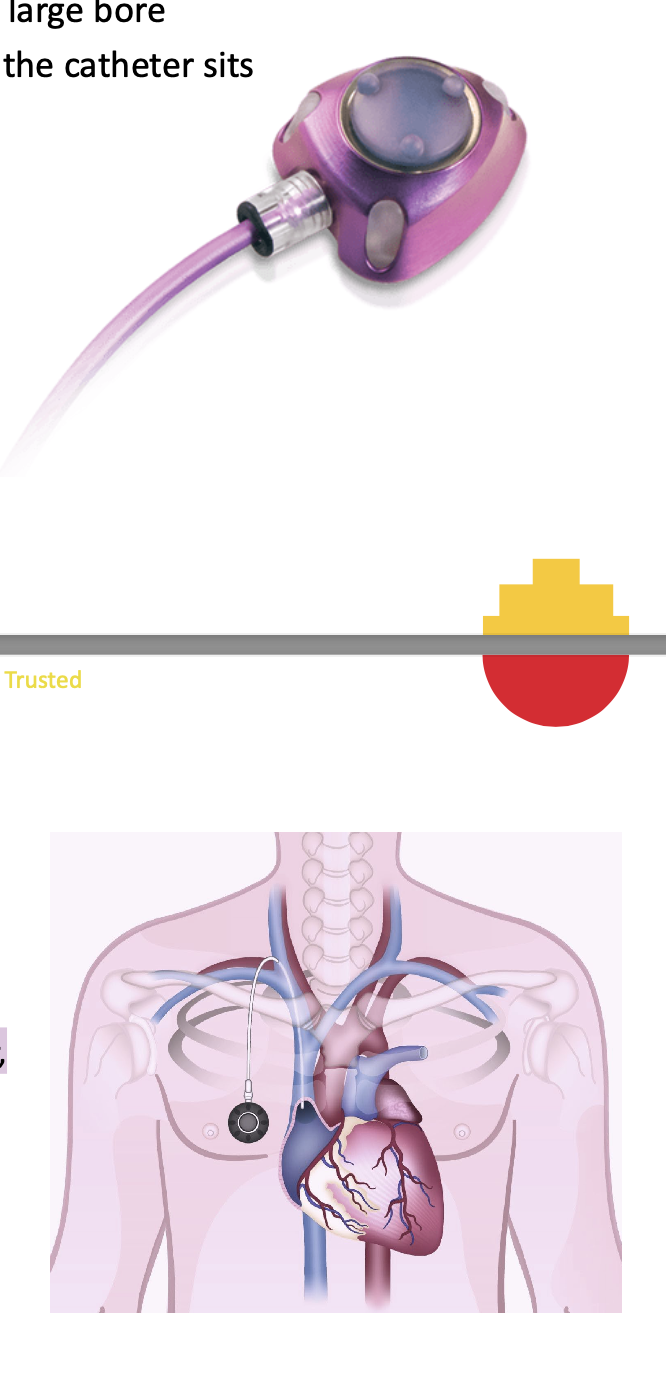 <p class="p1">A totally implanted vascular access device. Made up of a</p><p class="p1">silicone covered chamber that is attached to a large bore</p><p class="p1">catheter. The chamber sits under the skin and the catheter sits</p><p class="p1">in a central vessel.</p><p class="p1"></p><p class="p1">• Commonly used when long-term central venous</p><p class="p1">access is required.</p><p class="p1">• 6F, 8F size</p><p class="p1">• Single lumen ports are the most common, however,</p><p class="p1">double lumen ports are available that have two</p><p class="p1">separate chambers.</p><p class="p1">• Inserted in the chest or upper arm.</p><p class="p1">• heparin-locked when not in use.</p><p class="p1"></p><p class="p1">A port must be accessed with a specially</p><p class="p1">designed, non-coring needle (a port-specific</p><p class="p1">needle that will not damage the port</p><p class="p1">chamber).</p><p class="p1">Different non-coring needles are required for</p><p class="p1">pressure injectable ports – these are labelled</p><p class="p1">with how many mls/sec can be injected.</p><p class="p1">These specialised non-coring needles can be</p><p class="p1">used with any port, whether pressure</p><p class="p1">injectable or not</p>