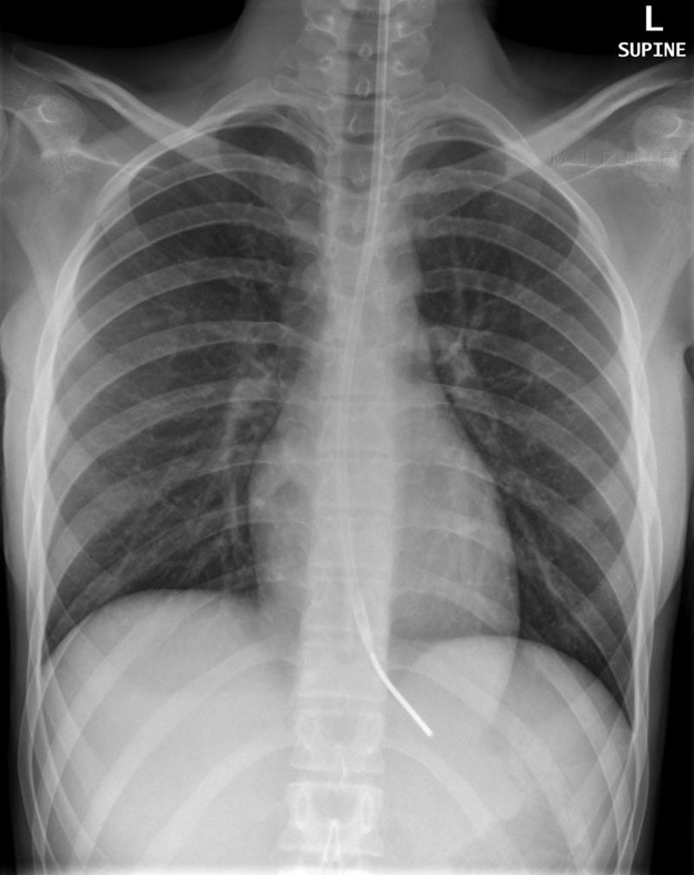 <p>used to decompress stomach; end of tube should be in the stomach and to the left of the spine</p>