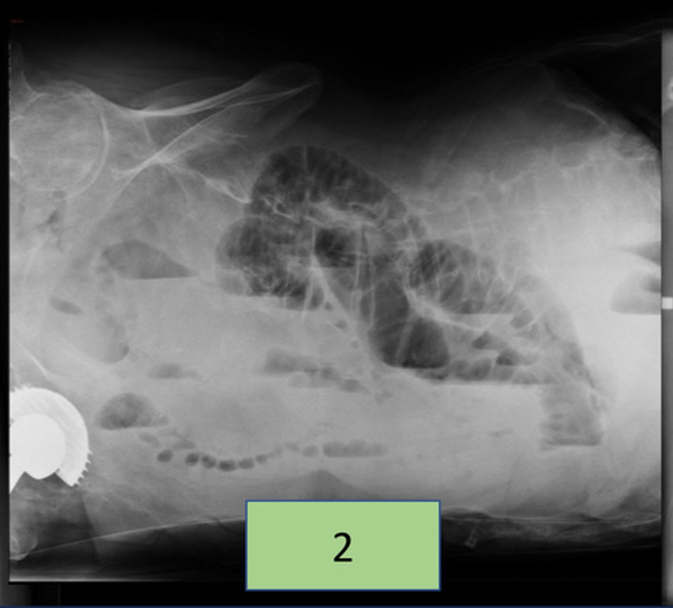 <p>used to ID free intraperitoneal gas (pneumoperitoneum); can be performed when the patient is unable to be transferred to, or other imaging modalities are not available</p>