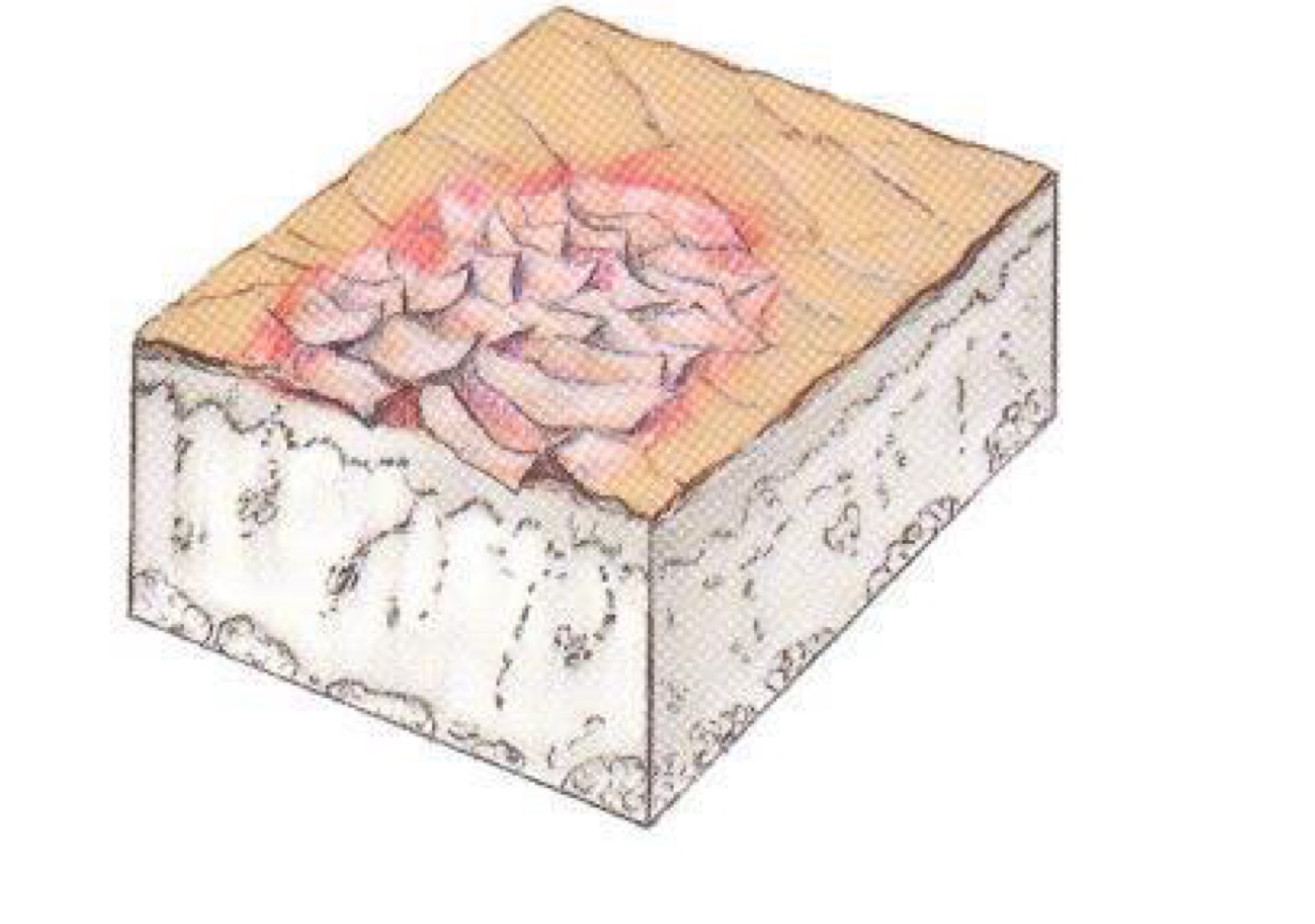 <p>what type of skin lesion is this? </p>