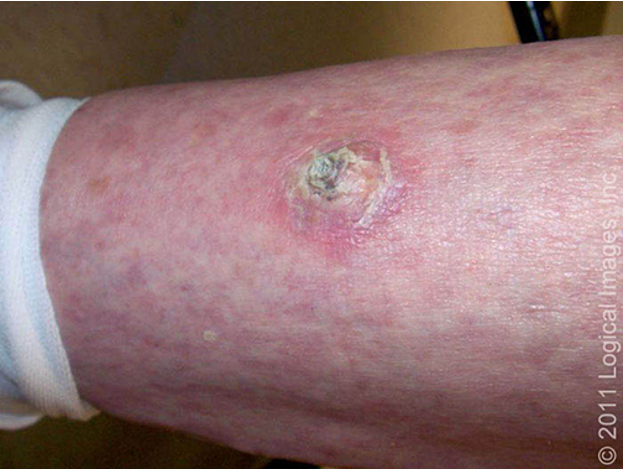 <ul><li><p>may present in multiple ways- papules, scaly or crusted plaques, nodules, hyperkeratotic</p></li><li><p>grows over wks-mos</p></li><li><p>may ulcerate</p></li><li><p>lesions may be tender/painful</p></li><li><p><strong>can present as in situ vs invasive</strong></p></li></ul><p></p>
