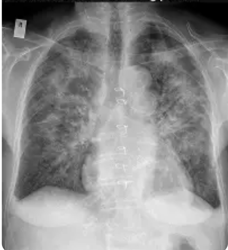 <ul><li><p>“<strong>batwing</strong>” pattern</p></li><li><p>increased cardiac silhouette sign</p></li><li><p>pleural effusions present</p></li></ul><p></p>