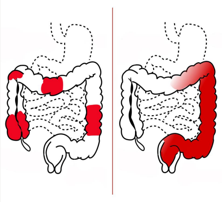 Crohn's Disease (left image) & Ulcerative colitis (right image)