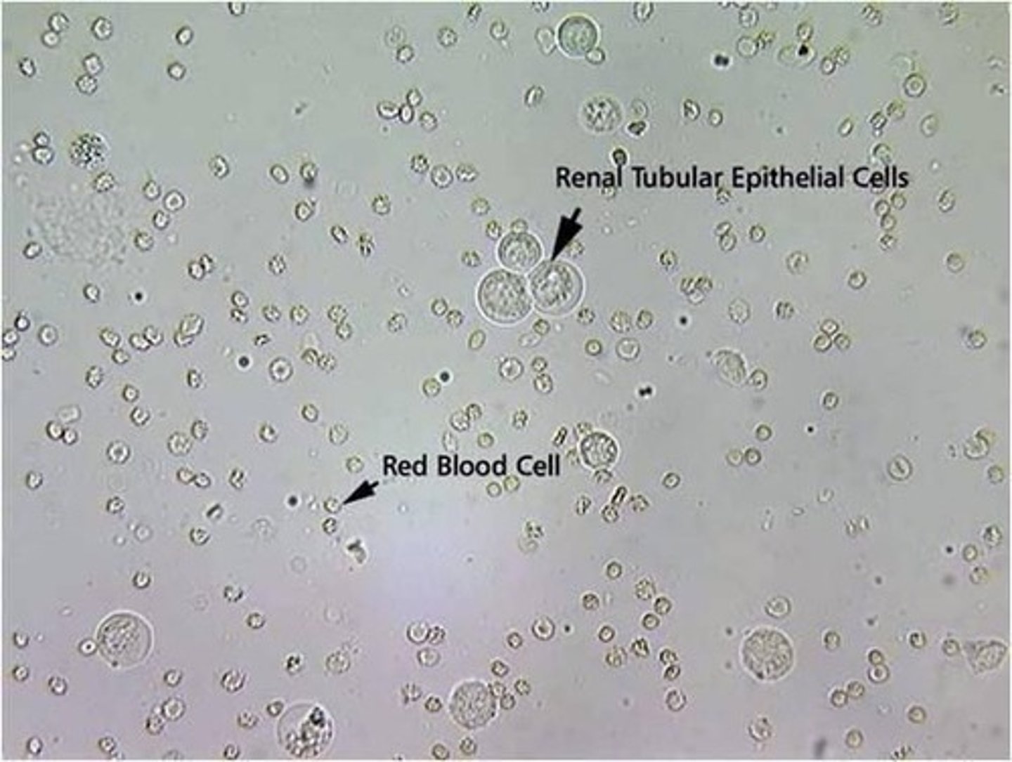<p>Smallest epithelial cell; originate in renal tubules; often confused with RBCs; generally round and contain a large nucleus with nongranular cytoplasm; rarely found</p>