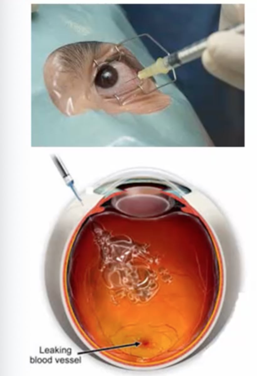 <p>Treatment includes stopping angiogenesis through laser photocoagulation, photodynamic therapy, and intravitreal anti-VEGF injections.</p>