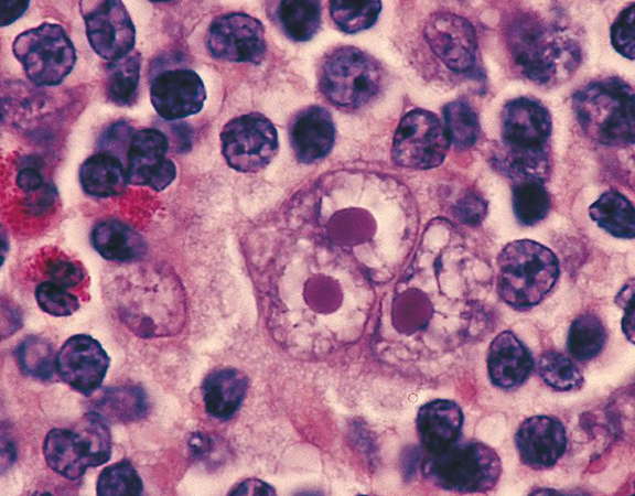 <p>neoplasm that develops from malignant lymphocytes <br>- reed-sternberg cell is the malignant lymphocyte, spreads to adjacent nodes, inflammatory cytokines release symptoms: enlarged, painless lymph nodes</p>