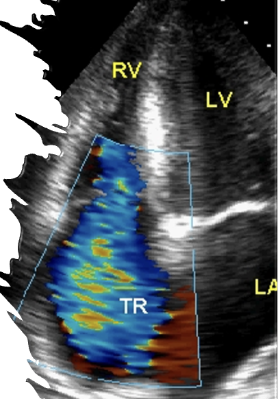 <p><span>As the right ventricle contracts to pump blood forward to the lungs, some blood leaks backward into the right atrium, increasing the volume of blood in the atrium. As a result, the <strong>______________</strong>, which can change the pressure in the nearby chambers and blood vessels.</span></p>