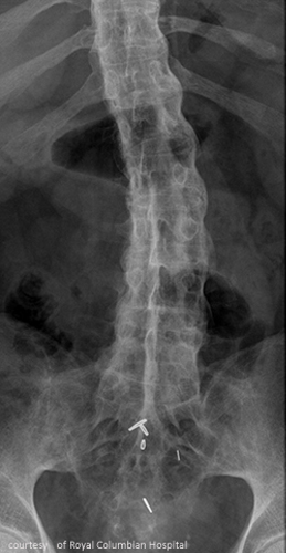 <p>Sacroiliac joints.</p>