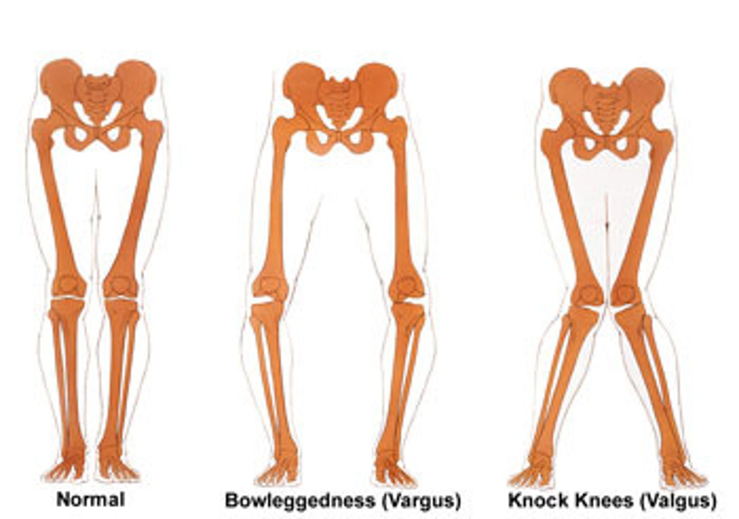 <p>distal segment (foot) deviates toward midline relative to proximal segment</p>