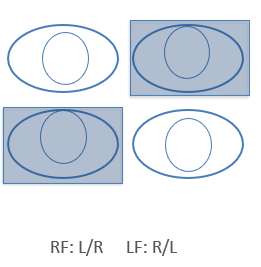 <ul><li><p><span>Hoogstand en excyclostand van het niet-fixerend oog. Bij fixatie met het rechteroog bestaat er dus een hoogstand van OS, bij fixatie met het linkeroog bestaat er een hoogstand van OD.</span></p></li><li><p><span>Latent of manifest</span></p></li><li><p><span>Frequent geassocieerd met nystagmus latens (horizontaal en/of rotatoir)</span></p></li><li><p><span>Frequent geassocieerd met early onset esotropie</span></p></li></ul><p></p><p><span>Grootste kenmerk, als je met rechts fixeert&nbsp; hoogstand OS,</span></p><p style="text-align: left"><span>Met LF: hoogstand OD</span></p><p></p>