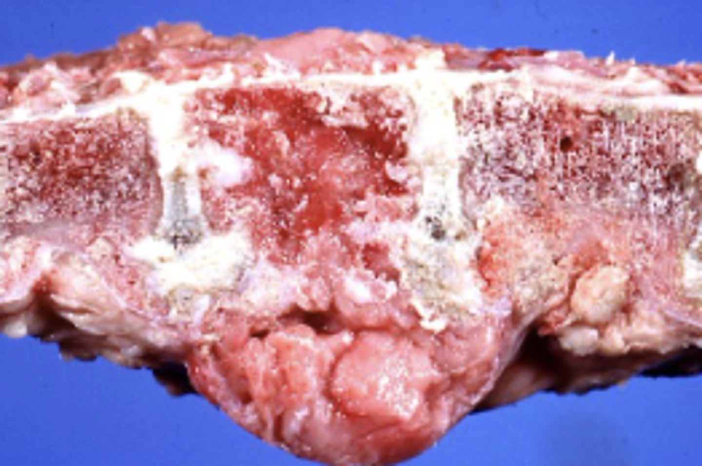 <p>What kind of tumor is this?</p>