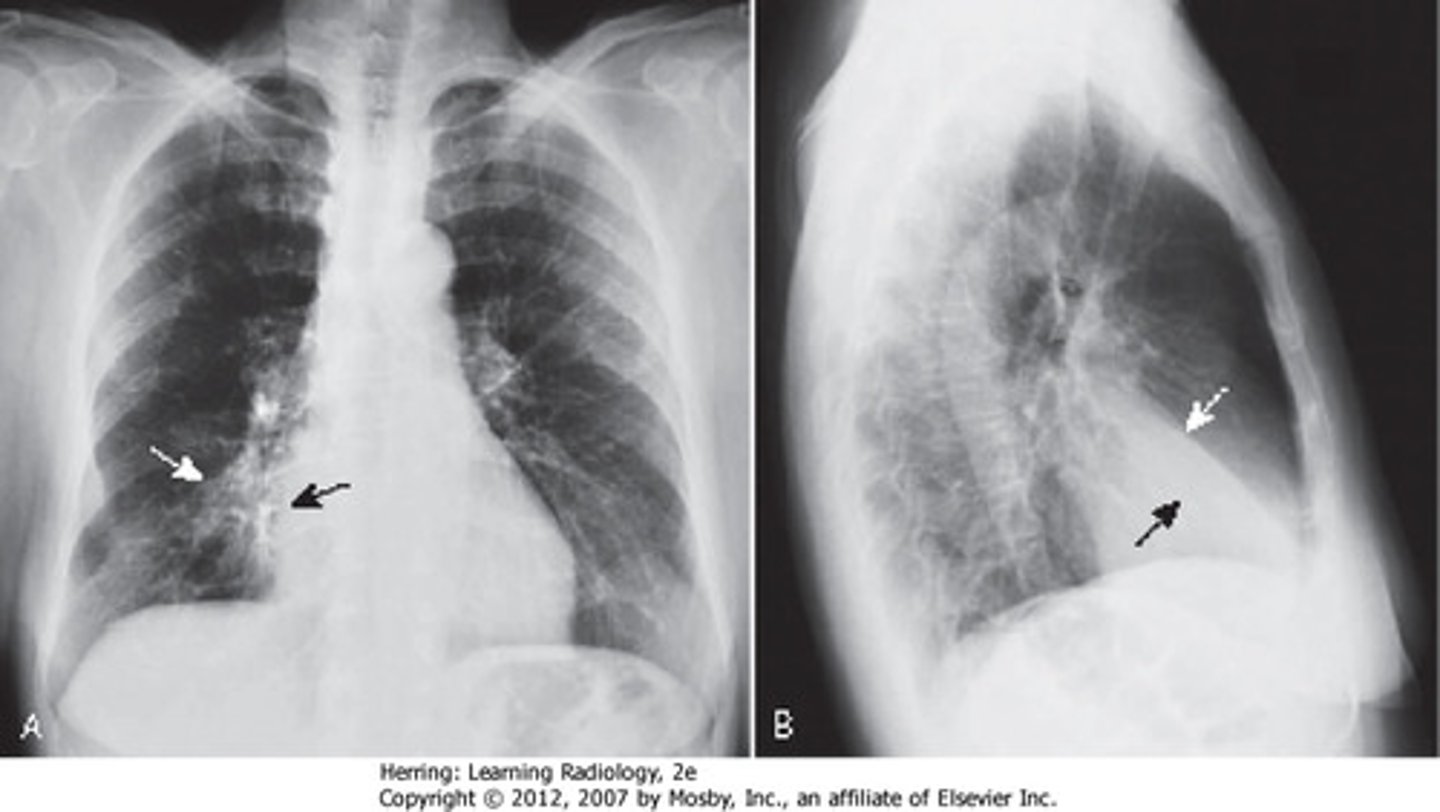 <p>Opposite apex</p><p>boundary</p>