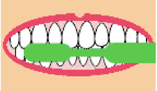 <ul><li><p>teeth closed </p></li><li><p>tip of bristles gently placed against side of posteriors </p></li><li><p>Brush swept vigorously over the tooth surface in a circular motion </p></li><li><p>over both upper and lower teeth and work your way forward </p></li></ul><p></p>