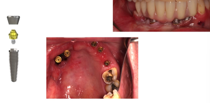 Healing cap, abutment then bridge