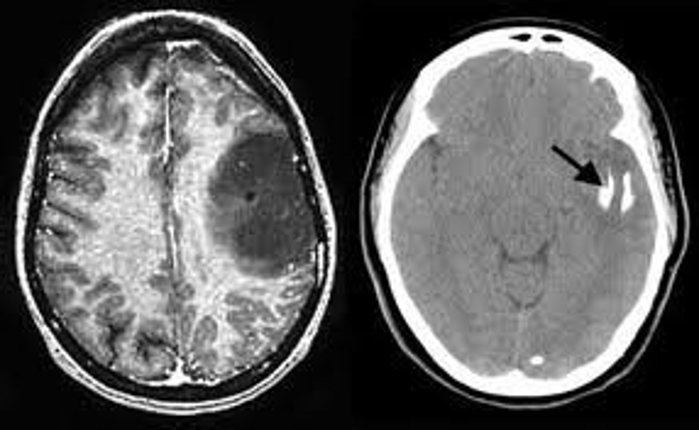 <p>1p/19q co-deletion &amp; IDH mutation</p>