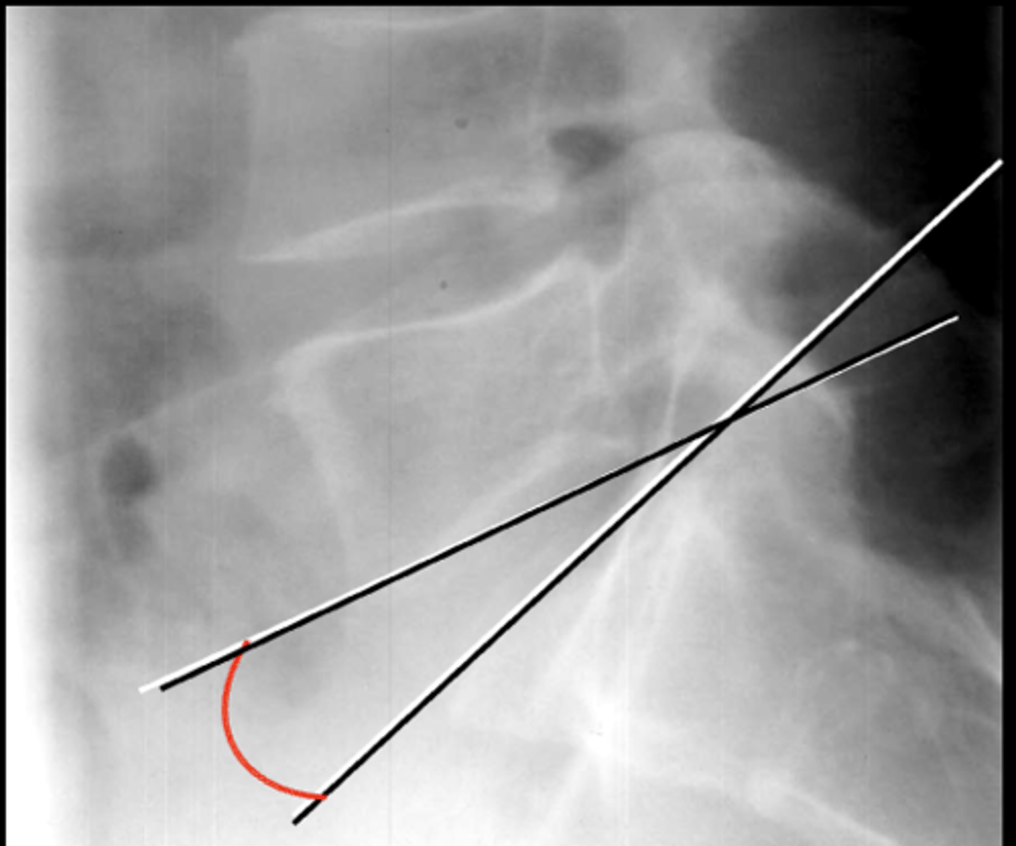 <p>The _____ measures the lumbosacral disc</p>