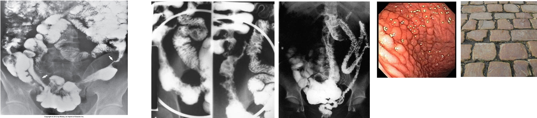 Arrows point to widely separated areas of disease (skip lesions). The lesions are greatly narrowed segments of small bowel. In other words, damaged areas in intestines between healthy and undamaged areas.
