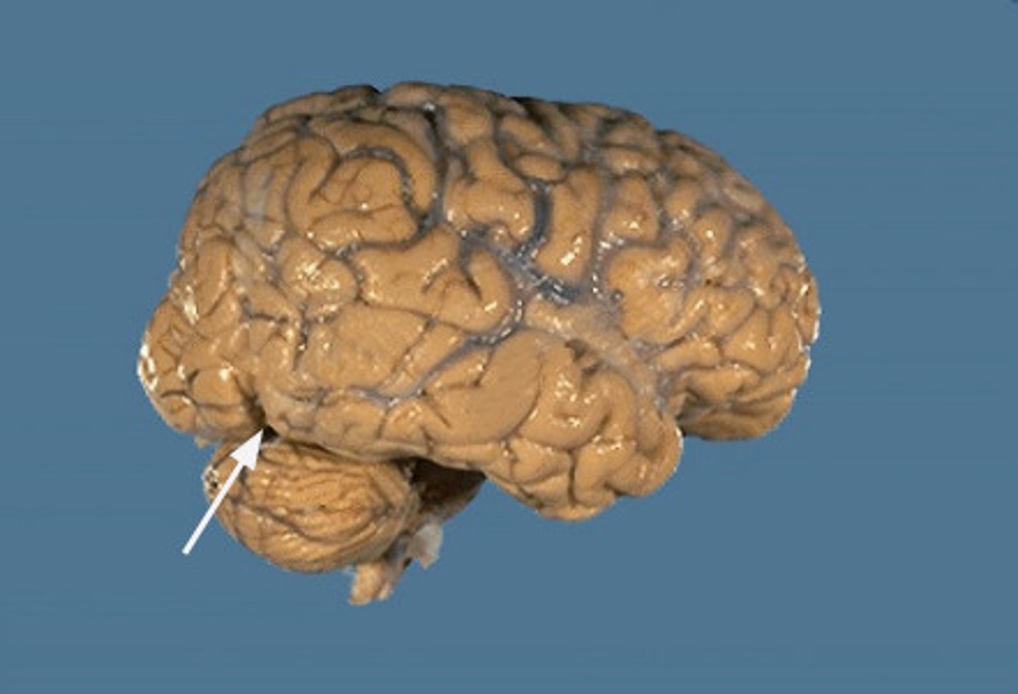 <p>the notch that serves as the bottom point of the imaginary dividing line between the temporal and occipital lobes; the top of the parieto-occipital sulcus is the top point</p>